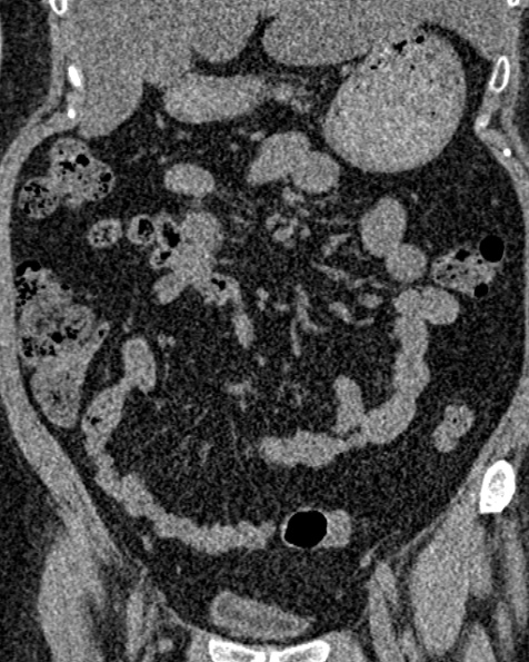 File:Nephrostomy for urosepsis (Radiopaedia 26180-26330 non-contrast 34).jpg
