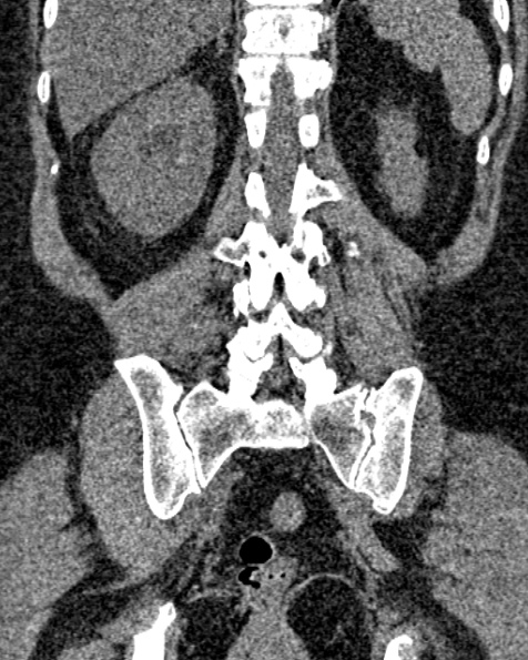 File:Nephrostomy for urosepsis (Radiopaedia 26180-26330 non-contrast 66).jpg