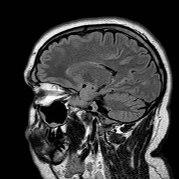 File:Neuro-Behcet's disease (Radiopaedia 21557-21506 Sagittal FLAIR 12).jpg