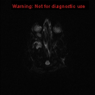File:Neurofibromatosis type 1 with optic nerve glioma (Radiopaedia 16288-15965 Axial DWI 44).jpg