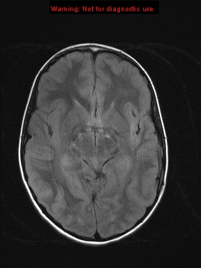 File:Neurofibromatosis type 1 with optic nerve glioma (Radiopaedia 16288-15965 Axial FLAIR 14).jpg