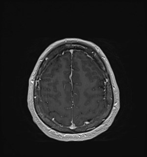 Neurofibromatosis type 2 (Radiopaedia 79097-92049 Axial T1 C+ 161).jpg