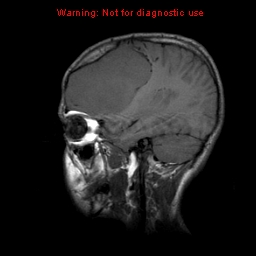 File:Neurofibromatosis type 2 (Radiopaedia 8953-9730 Sagittal T1 16).jpg