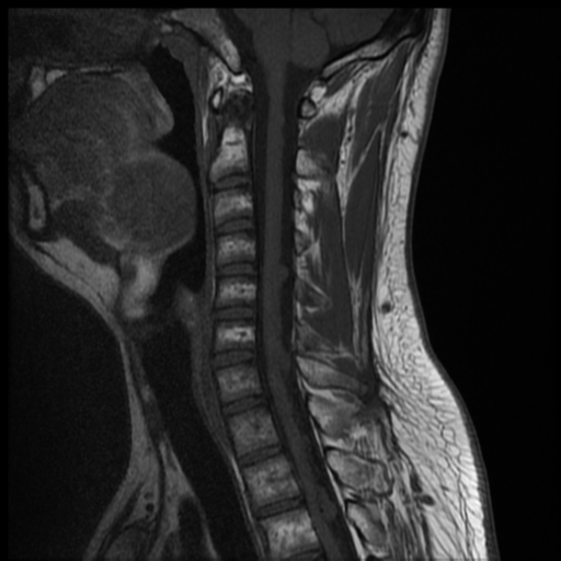 File:Neurofibromatosis type 2 (spinal manifestations) (Radiopaedia 53943-60070 Sagittal T1 7).png