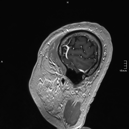 Neurosarcoidosis - involvement of the mesial temporal lobes (Radiopaedia 67429-76820 Sagittal T1 C+ 152).jpg