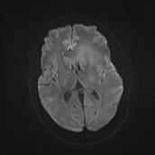File:Neurotoxoplasmosis - concentric target sign (Radiopaedia 70644-80784 Axial DWI 12).jpg