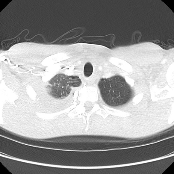 File:Non-Hodgkin lymphoma involving lung (Radiopaedia 29094-29470 Axial lung window 12).jpg