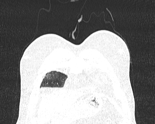 Non-specific interstitial pneumonia (NSIP) (Radiopaedia 68599-78228 Coronal lung window 2).jpg