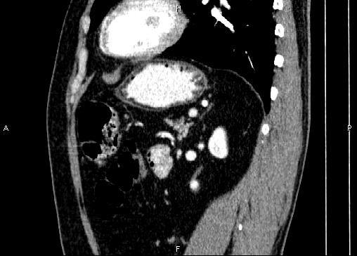 Non-syndromic pancreatic endocrine tumor (Radiopaedia 86958-103178 E 70).jpg