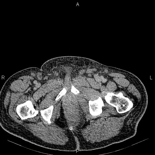 Non Hodgkin lymphoma in a patient with ankylosing spondylitis (Radiopaedia 84323-99621 Axial C+ delayed 88).jpg