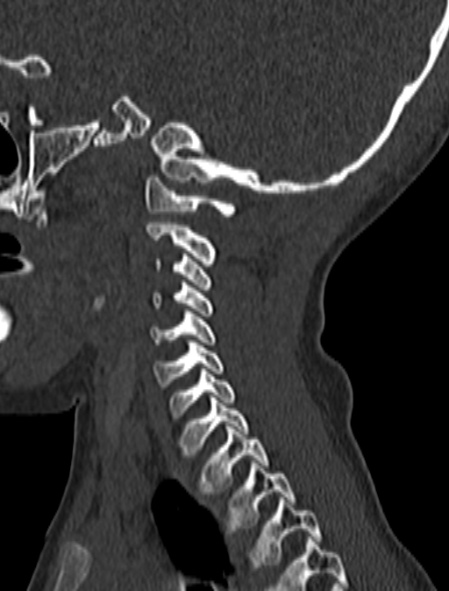 Normal CT cervical spine - pediatric (Radiopaedia 52549-58462 Sagittal bone window 48).jpg