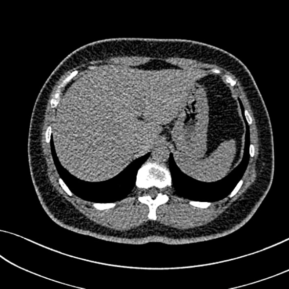 Normal CT chest- adult female (Radiopaedia 52522-58428 Axial non-contrast 118).jpg