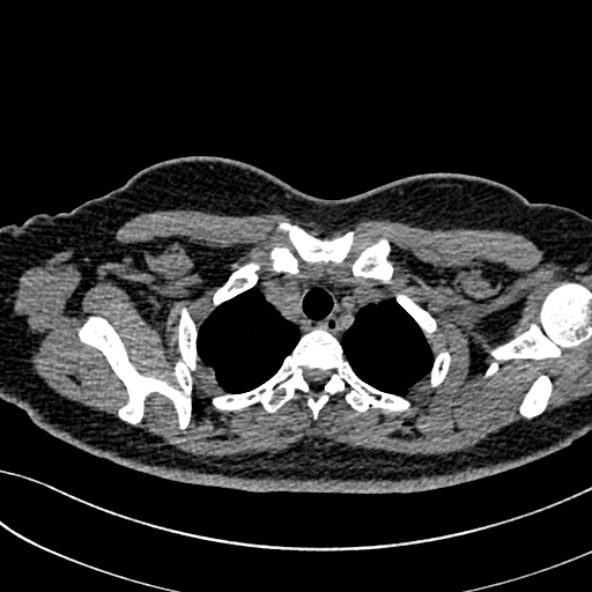 Normal CT chest- adult female (Radiopaedia 52522-58428 Axial non-contrast 22).jpg