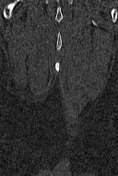Normal CT lumbar spine (Radiopaedia 53981-60118 Coronal bone window 73).jpg