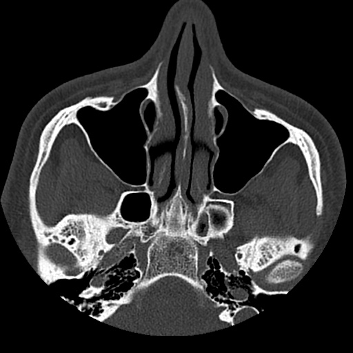 Normal CT paranasal sinuses (Radiopaedia 42286-45390 Axial bone window 72).jpg