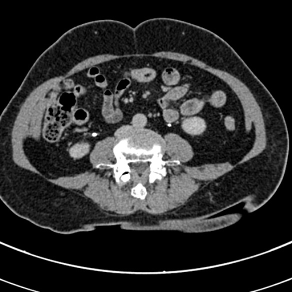 File:Normal CT split bolus study of the renal tract (Radiopaedia 48631-53634 Axial split bolus 155).jpg