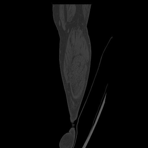 Normal CT tibia and fibula (Radiopaedia 51195-56848 Coronal non-contrast 62).jpg