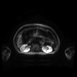 Normal MRI abdomen in pregnancy (Radiopaedia 88001-104541 Axial DWI 77).jpg