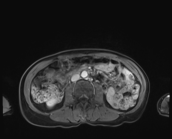 Normal adrenal glands MRI (Radiopaedia 82017-96004 K 53).jpg