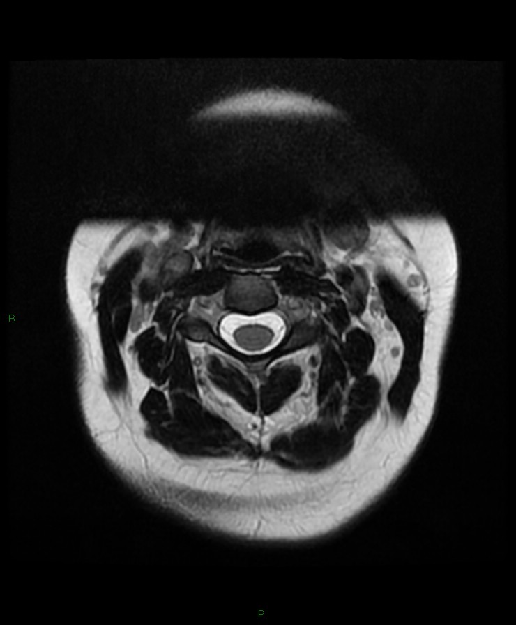 Normal cervical spine MRI (Radiopaedia 80146-93454 Axial T2 23).jpg