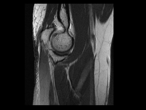 File:Normal elbow arthrograms (Radiopaedia 75550-86805 Sagittal PD 27).jpg