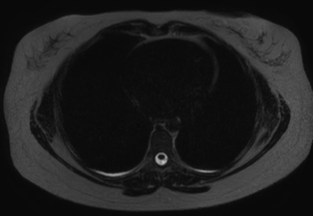 File:Normal liver MRI with Gadolinium (Radiopaedia 58913-66163 E 34).jpg