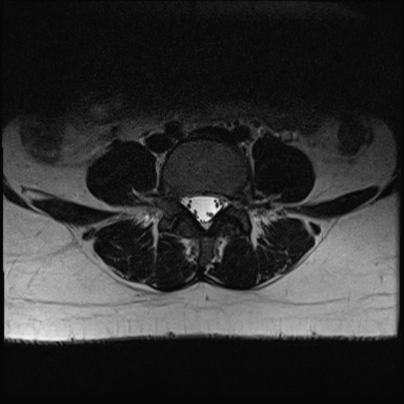 File:Normal lumbar spine MRI- 3 T (Radiopaedia 53280-59250 Axial T2 20).jpg