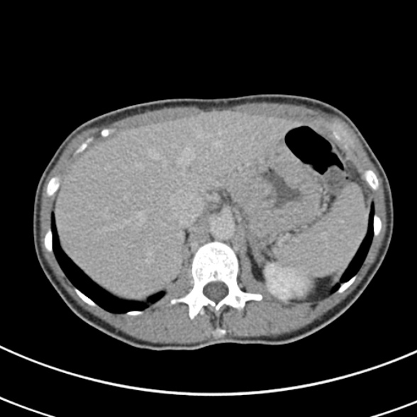 File:Normal multiphase CT liver (Radiopaedia 38026-39996 Axial C+ delayed 17).jpg