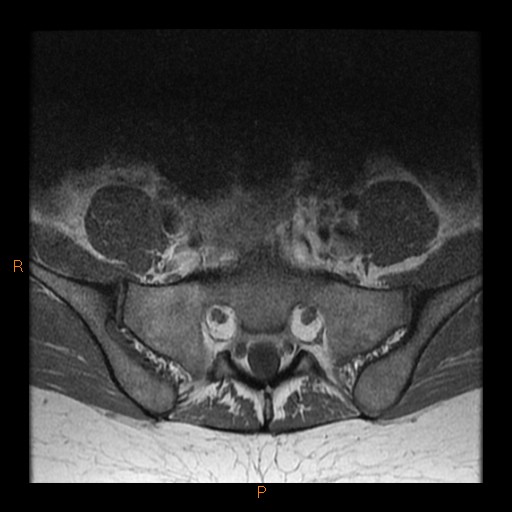 File:Normal spine MRI (Radiopaedia 77323-89408 Axial T1 28).jpg