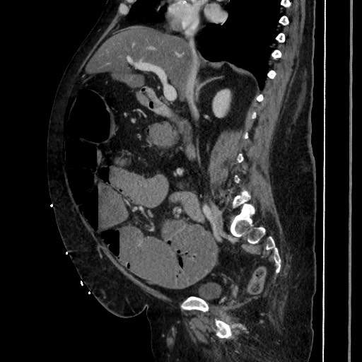Obstructive colonic diverticular stricture (Radiopaedia 81085-94675 C 108).jpg