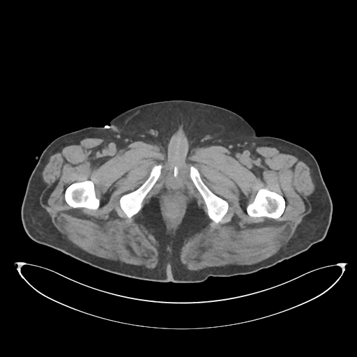 File:Obstructive pyelonephritis (Radiopaedia 46411-50844 Axial non-contrast 85).png