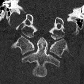File:Occipital condyle fracture (Radiopaedia 18366-18209 Coronal 1).jpg