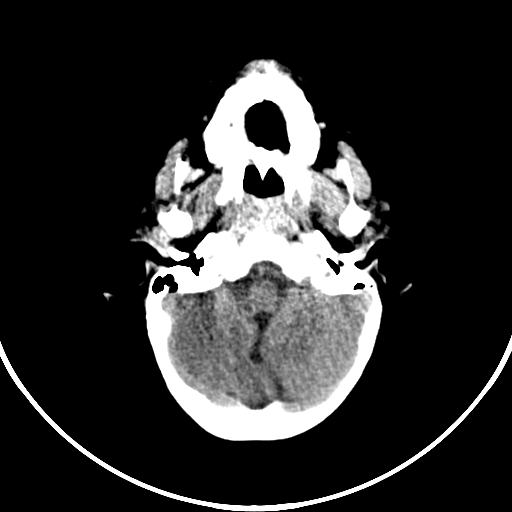 Occipital encephalocele (Radiopaedia 87339-103636 Axial non-contrast 21).jpg