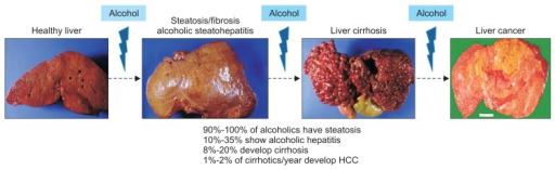 Progression for alcoholic liver injury to steatosis with scarring, and architectural distortion leading to cirrhosis; as a complication of cirrhosis, hepatocellular carcinoma may occur