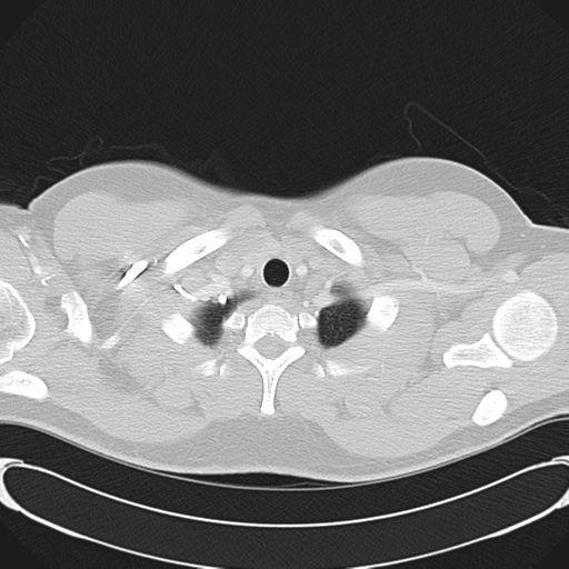 'Bovine' aortic arch (Radiopaedia 33554-34637 Axial lung window 6).png