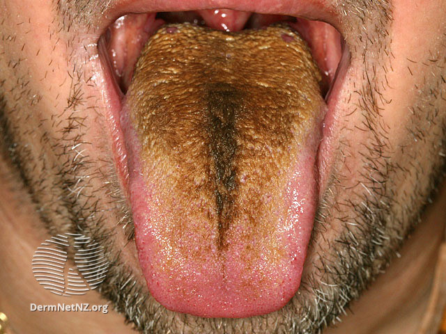 File:(DermNet NZ site-age-specific-s-black-hairy-tongue-2).jpg