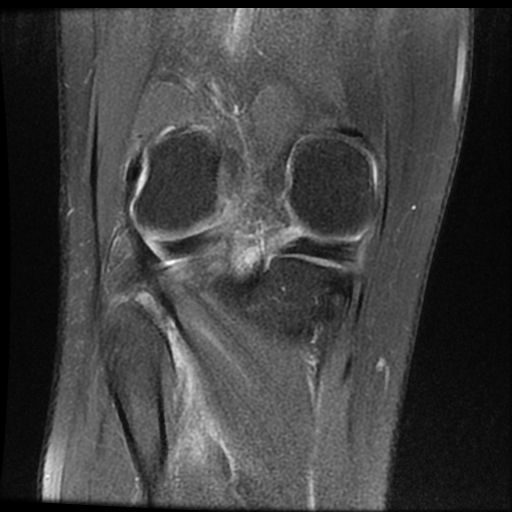 File:ACL acute full thickness tear - deep lateral femoral sulcus sign (Radiopaedia 38594-40740 Coronal PD fat sat 16).jpg