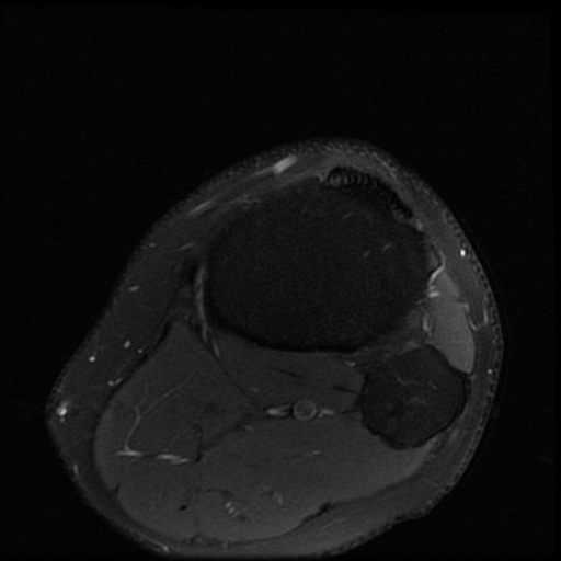 File:ACL and meniscal tears (Radiopaedia 79604-92797 Axial PD fat sat 23).jpg
