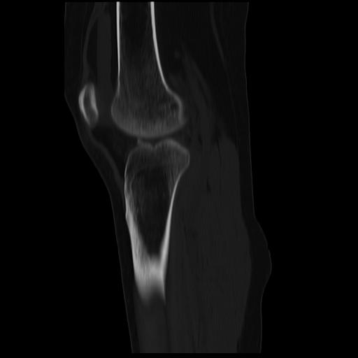 File:ACL avulsion fracture (Radiopaedia 33833-34994 Sagittal bone window 18).jpg