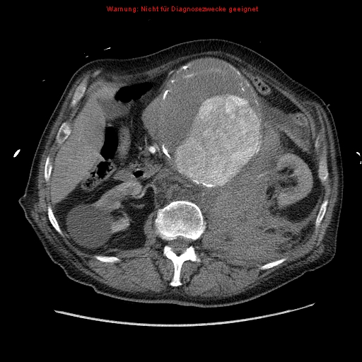 Abdominal aortic aneurysm- extremely large, ruptured (Radiopaedia 19882-19921 Axial C+ arterial phase 27).jpg