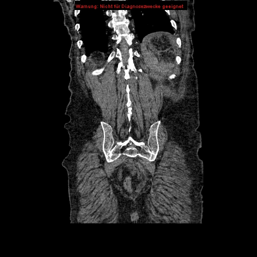 Abdominal aortic aneurysm- extremely large, ruptured (Radiopaedia 19882-19921 Coronal C+ arterial phase 89).jpg