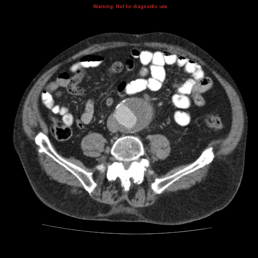 Abdominal aortic aneurysm (Radiopaedia 10122-10660 Axial C+ portal venous phase 51).jpg