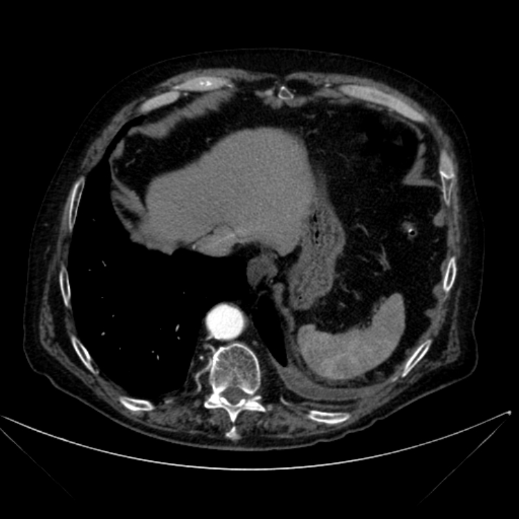 Abdominal aortic aneurysm (Radiopaedia 25855-26001 Axial C+ arterial phase 22).jpg