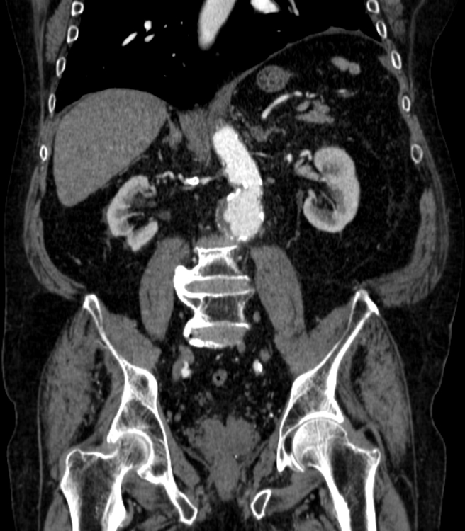 Abdominal aortic aneurysm (Radiopaedia 25855-26001 Coronal C+ arterial phase 42).jpg