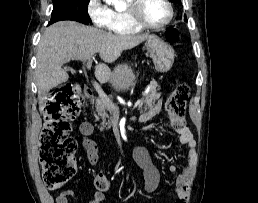 Abdominal aortic aneurysm (Radiopaedia 67117-76452 Coronal C+ arterial phase 21).jpg