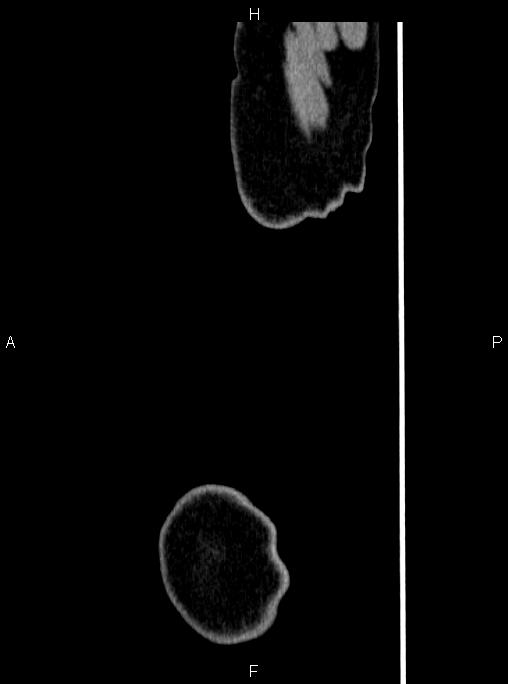 Abdominal aortic aneurysm (Radiopaedia 83094-97462 Sagittal renal cortical phase 131).jpg