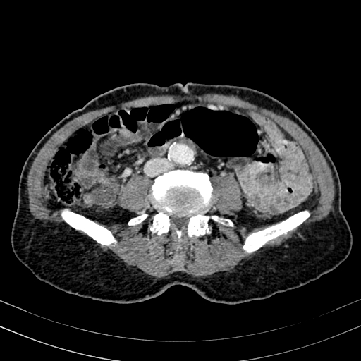 Abdominal aortic aneurysm (Radiopaedia 83581-98689 Axial C+ portal venous phase 68).jpg
