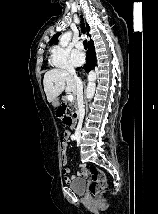 Abdominal aortic aneurysm (Radiopaedia 85063-100606 Sagittal C+ arterial phase 37).jpg