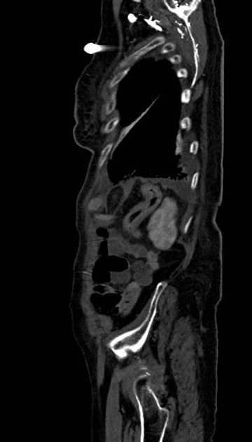Abdominal aortic aneurysm with thrombus fissuration (Radiopaedia 73192-83919 Sagittal C+ arterial phase 12).jpg
