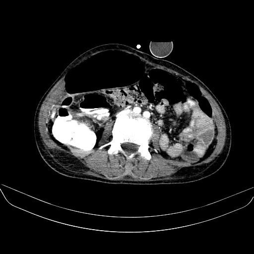 File:Abdominal collection due to previous cecal perforation (Radiopaedia 80831-94320 Axial C+ portal venous phase 114).jpg